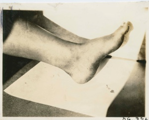 Image of Arch of a foot